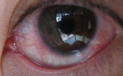 眼睛红血丝怎么办,实用护理与改善方法